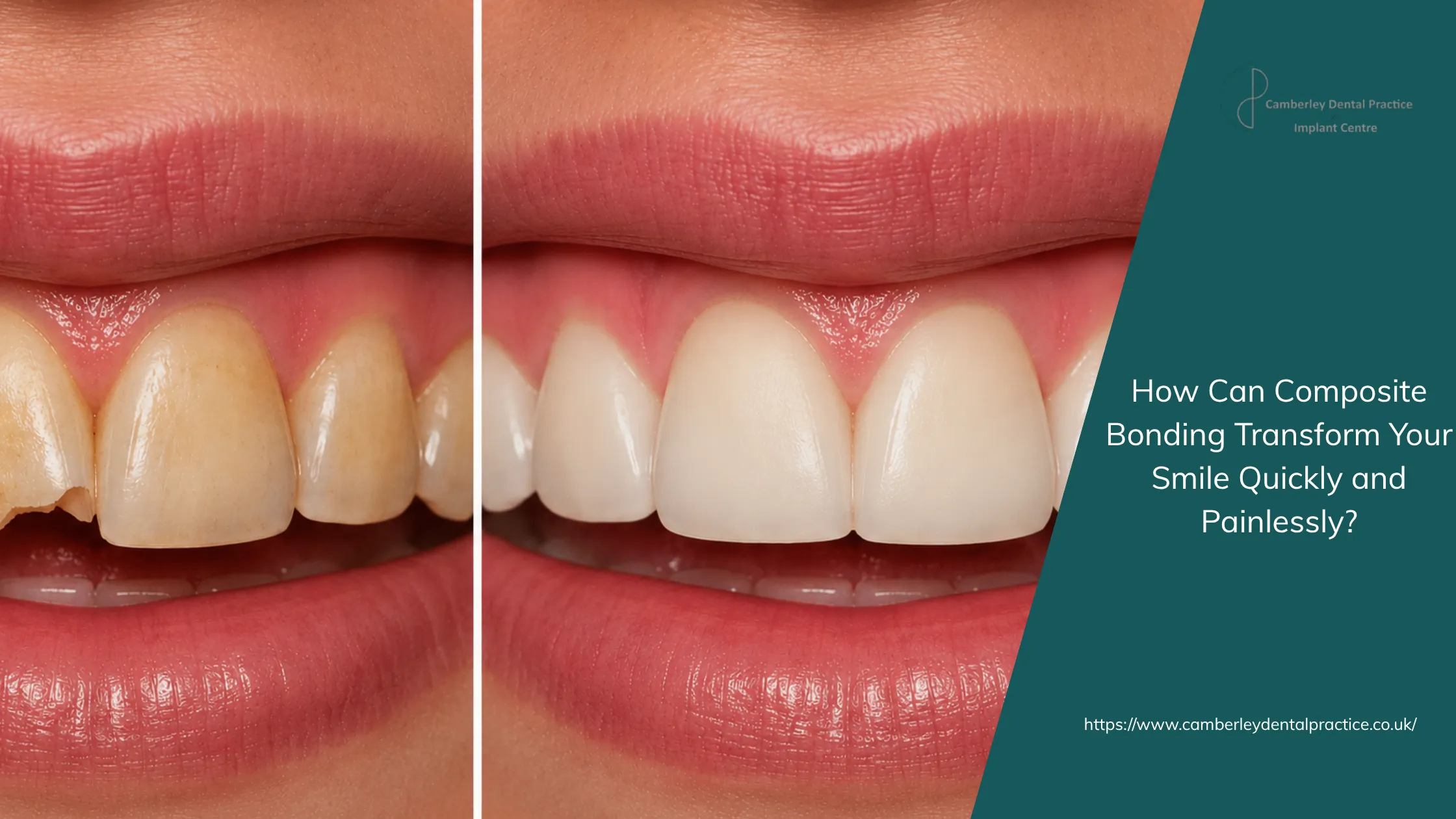How Can Composite Bonding Transform Your Smile Quickly and Painlessly?