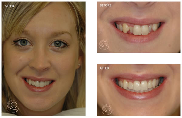 Before and after Cfast treatment